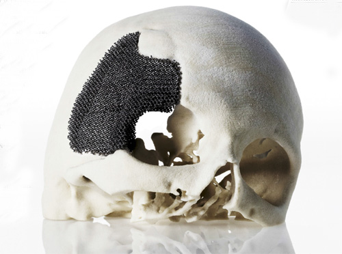 3D打印頭蓋骨